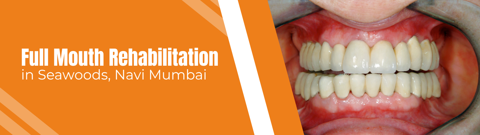 Full mouth rehabilitation treatment at Age Concepts dental clinic in Seawoods, Navi Mumbai Full mouth rehabilitation treatment at Age Concepts dental clinic in Seawoods, Navi Mumbai