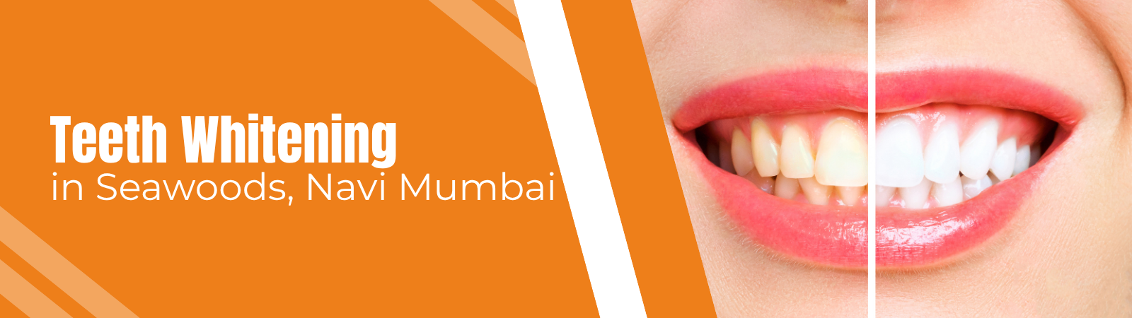 Professional teeth whitening treatment at Age Concepts, Seawoods Navi Mumbai