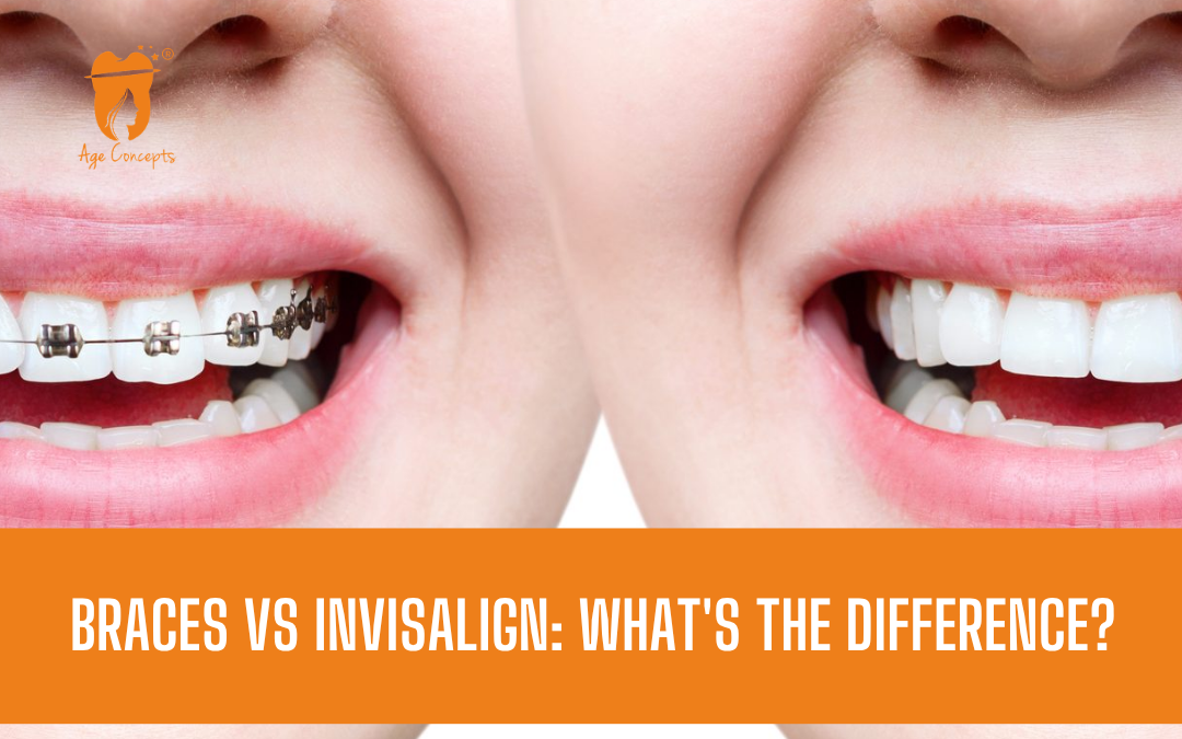 Braces vs Invisalign What's the Difference
