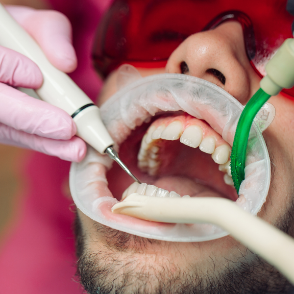 Full Mouth Dental Implant Restoration - Age Concepts Navi Mumbai