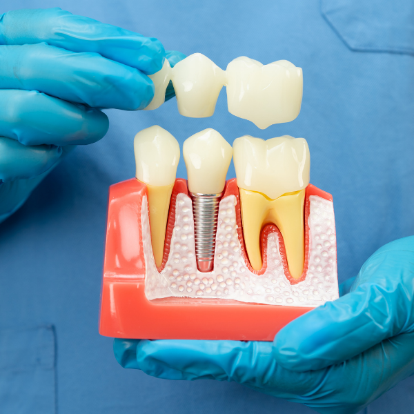 Single Tooth Dental Implant Before and After - Age Concepts Navi Mumbai