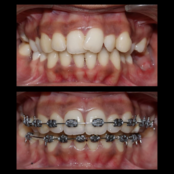 Before-and-after dental image showing teeth with braces: top panel misaligned teeth, bottom panel braces with metal brackets and wires across both arches