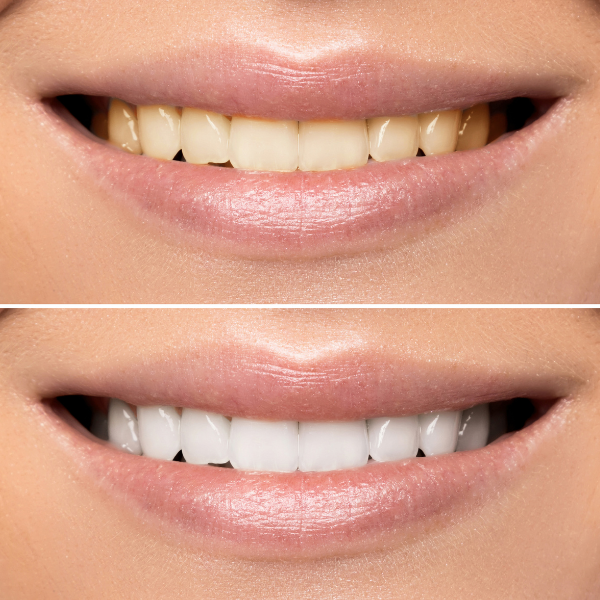 Two-panel image showing a smile before and after teeth whitening: top teeth are yellowish, bottom teeth are bright white.