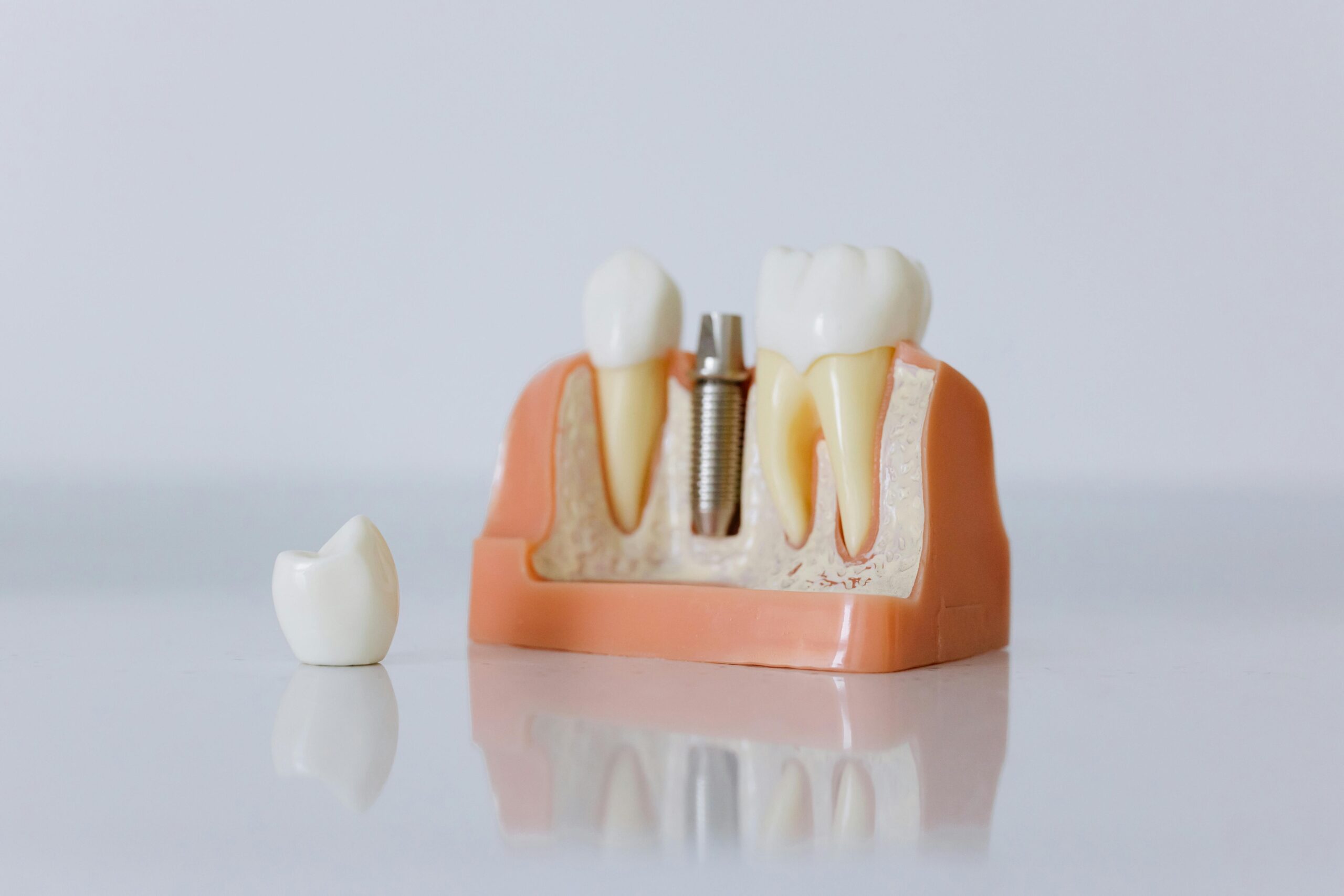 Dental model showing a dental implant placed in the jawbone next to a separated tooth crown piece.