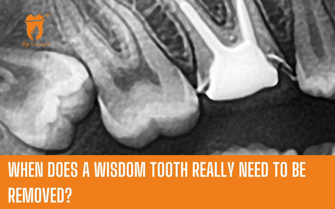 When does a wisdom tooth really need to be removed?