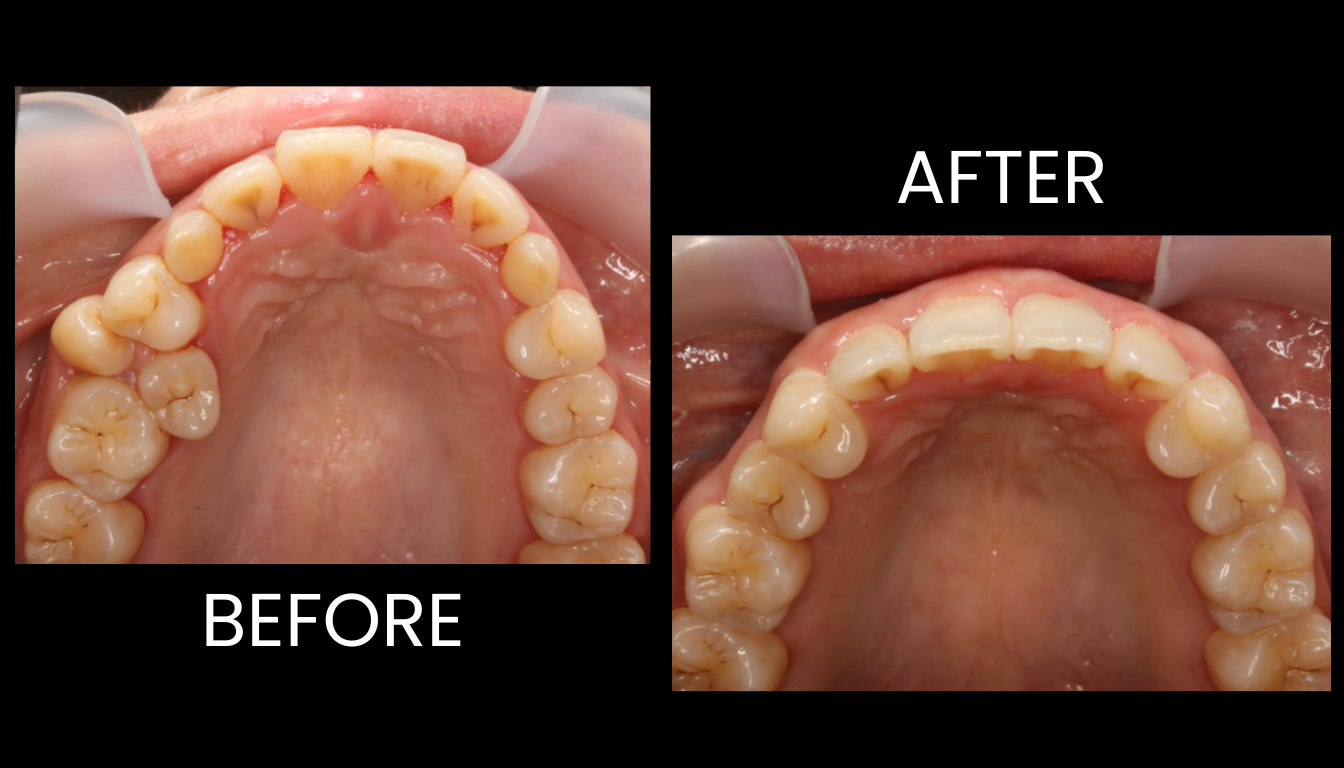 Before and after: view of the upper dental arch showing crowding before treatment (left) and improved alignment after treatment (right).