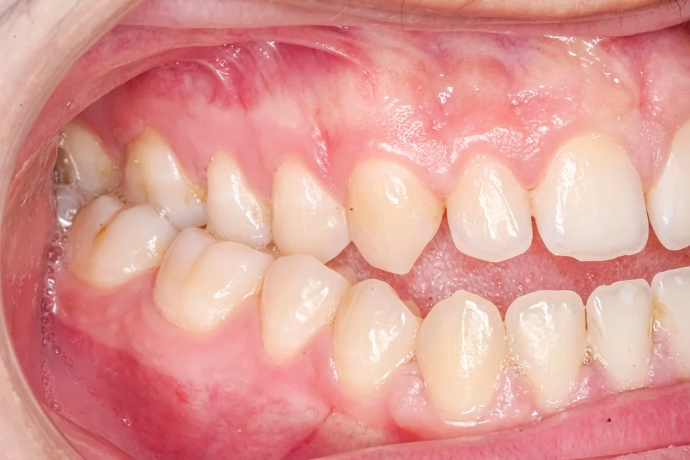 Close-up of a side view of teeth showing crowding in the lower arch and mildly inflamed gums on the left side of the mouth.