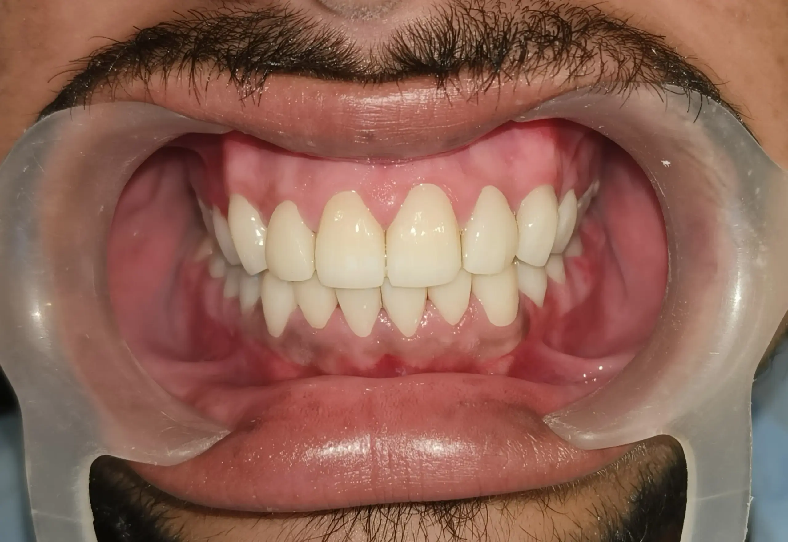 After: Post-operative full mouth rehabilitation result frontal view Age Concepts Seawoods Navi Mumbai Dr. Swapnil Bhagwat