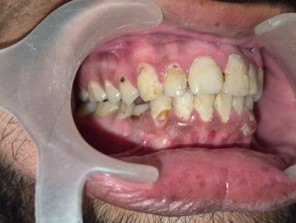 Before: Pre-operative generalised tooth decay frontal view Age Concepts Seawoods Navi Mumbai Dr. Swapnil Bhagwat