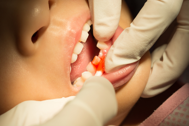 Picture2 Swollen gum