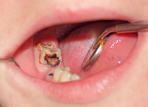 Picture2 decay near molar root causing pain while chewing