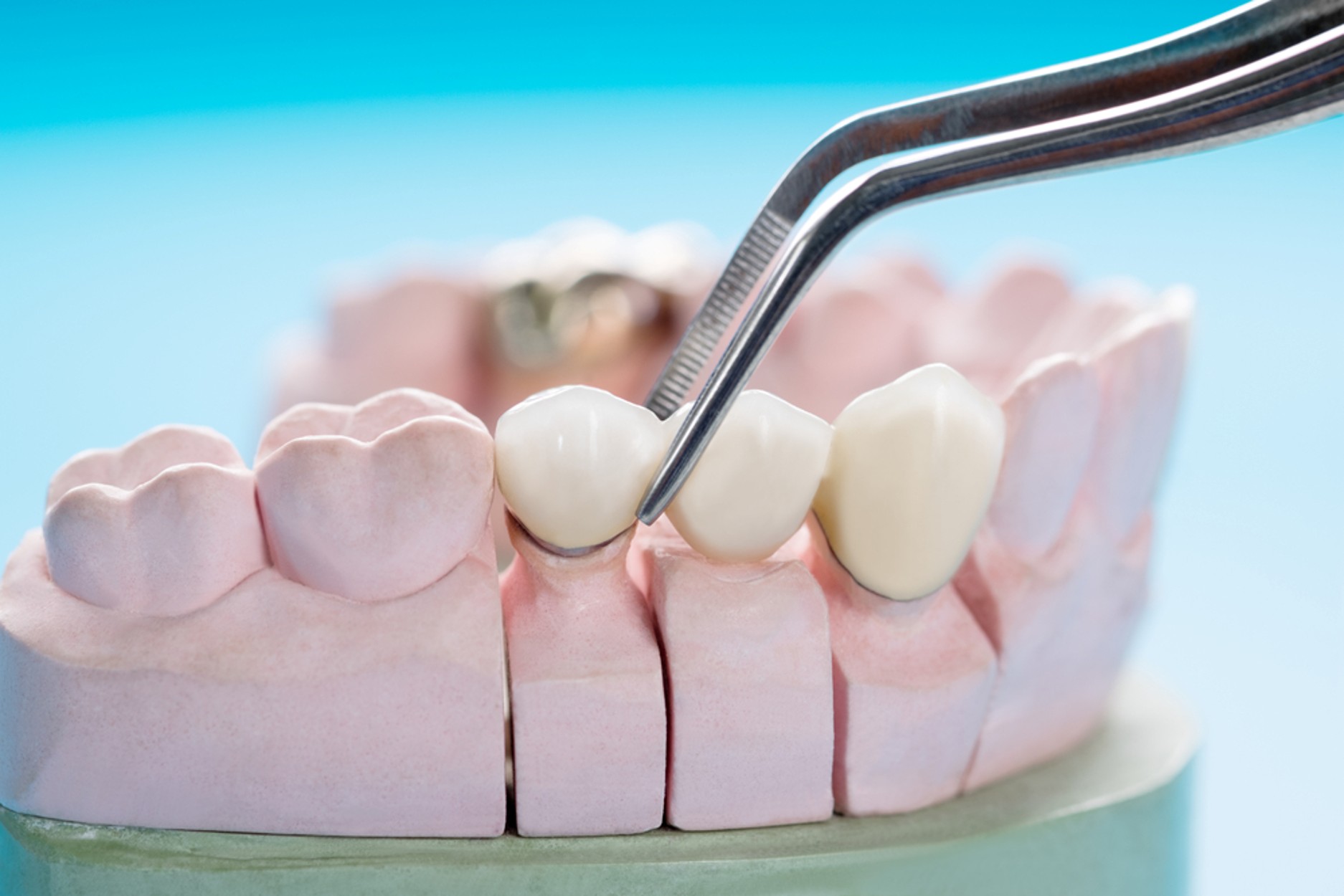 Picture3 a crown on a treated molar after root canal treatment