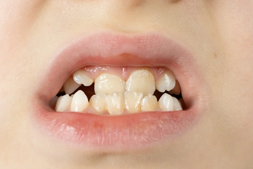 In-office teeth whitening treatment using light-activation technology at Age Concepts Navi Mumbai