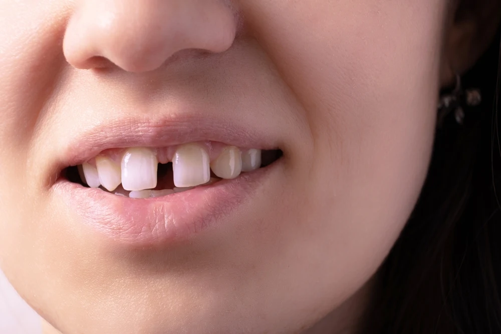 Close-up of a smile showing misaligned, uneven upper front teeth and crowding.