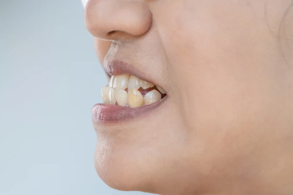 Close-up of a mouth showing crowded, misaligned teeth in a side profile area of the face, highlighting dental crowding